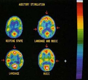 Image de l'activité du cerveau lorsqu'il est stimulé par des mots, par de la musique, des mots et de la musique